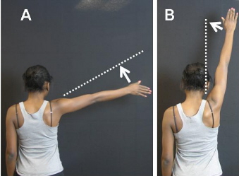 Photograph of patient showing range of motion