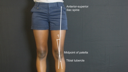 Photo of patient's legs with diagram